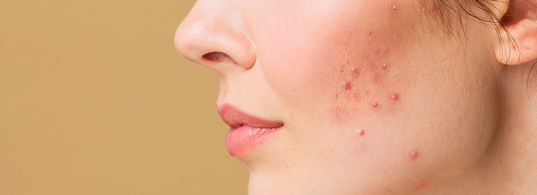 Tratamiento facial para piel con acné